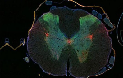 Studies have found that PARP inhibitors can alleviate amyotrophic lateral sclerosis
