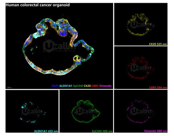 A 5-Plex Multiplex IHC Panel for Colon Cancer Organoids
