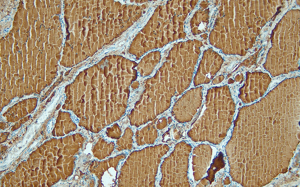 Anti-Thyroglobulin – Figure 1 of 2