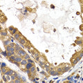 Immunohistochemistry of paraffin-embedded human stomach cancer using GYS1 antibody at dilution of 1:200 (400x lens).
