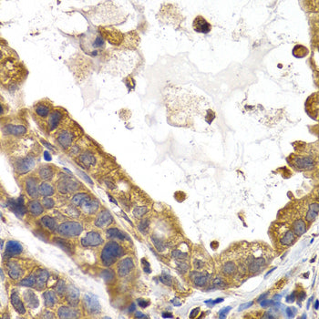 Immunohistochemistry of paraffin-embedded human stomach cancer using GYS1 antibody at dilution of 1:200 (400x lens).