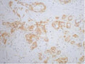 IHC staining of human breast cancer tissue, diluted at 1:200.
