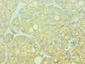 Immunohistochemical of paraffin-embedded human liver cancer using CSB-MA0014851A0m at dilution of 1:200