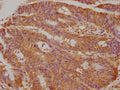 Immunohistochemical of paraffin-embedded human colon cancer using CSB-MA0234331A0m at dilution of 1:50