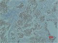 Immunohistochemical analysis of paraffin-embedded Human Lung caricnoma using Catenin-β Monoclonal Antibody.