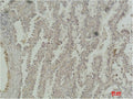 Immunohistochemical analysis of paraffin-embedded Human Lung Carcinoma using CREB-1 Monoclonal Antibody.