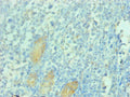 Immunohistochemical of paraffin-embedded human gastric cancer tissue using  CSB-MA112991A0m at dilution of 1:200