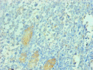 Immunohistochemical of paraffin-embedded human gastric cancer tissue using  CSB-MA112991A0m at dilution of 1:200