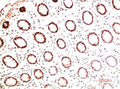 Immunohistochemical analysis of paraffin-embedded Human Colon Carcinoma Tissue using Collagen I  Mouse mAb diluted at 1:200.