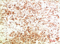 Immunohistochemical analysis of paraffin-embedded Human Ovarian Carcinoma Tissue using ATG5  Mouse mAb diluted at 1:200.