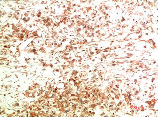 Immunohistochemical analysis of paraffin-embedded Human Ovarian Carcinoma Tissue using ATG5  Mouse mAb diluted at 1:200.