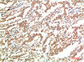 Immunohistochemical analysis of paraffin-embedded Human Lung Carcinoma Tissue using JAK2  Mouse mAb diluted at 1:200.