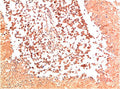Immunohistochemical analysis of paraffin-embedded Human Lung Carcinoma Tissue using Collagen II  Mouse mAb diluted at 1:200.