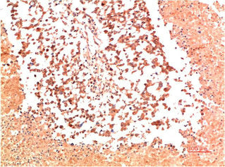 Immunohistochemical analysis of paraffin-embedded Human Lung Carcinoma Tissue using Collagen II  Mouse mAb diluted at 1:200.