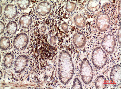 Immunohistochemical analysis of paraffin-embedded Human Colon Carcinoma Tissue using Epsilon Tubulin Mouse mAb diluted at 1:200.