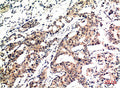 Immunohistochemical analysis of paraffin-embedded Human Breast Carcinoma Tissue using Ubiquitin Mouse mAb diluted at 1:200.