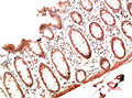 Immunohistochemical analysis of paraffin-embedded Human Colon Carcinoma Tissue using Collagen I  Mouse mAb diluted at 1:200.
