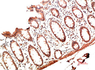 Immunohistochemical analysis of paraffin-embedded Human Colon Carcinoma Tissue using Collagen I  Mouse mAb diluted at 1:200.