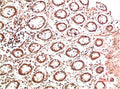 Immunohistochemical analysis of paraffin-embedded Human Colon Carcinoma Tissue using Collagen II Mouse mAb diluted at 1:500