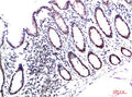 Immunohistochemical analysis of paraffin-embedded Human Colon Carcinoma Tissue using HP-1γ  Mouse mAb diluted at 1:200.