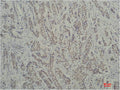 Immunohistochemical analysis of paraffin-embedded Human Breast Carcinoma using TBP/TATA Binding Protein（mAb diluted at 1:200.