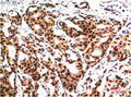 Immunohistochemical analysis of paraffin-embedded Human Breast CarcinomaTissue using Ubiquitin Mouse mAb diluted at 1:200.