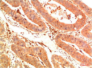 Immunohistochemical analysis of paraffin-embedded Human Colon Carcinoma Tissue using Acetyl P53(K382)  Mouse mAb diluted at 1:200.