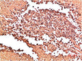 Immunohistochemical analysis of paraffin-embedded Human Lung Carcinoma Tissue using Collagen II  Mouse mAb diluted at 1:200.