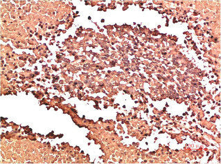 Immunohistochemical analysis of paraffin-embedded Human Lung Carcinoma Tissue using Collagen II  Mouse mAb diluted at 1:200.