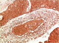 Immunohistochemical analysis of paraffin-embedded Human Breast Carcinoma Tissue using JAK2  Mouse mAb diluted at 1:200.