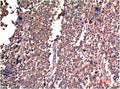 Immunohistochemical analysis of paraffin-embedded Human Lung Carcinoma Tissue using Cyclin B1 Mouse mAb diluted at 1:200.