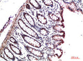 Immunohistochemical analysis of paraffin-embedded Human Colon Carcinoma Tissue using HP-1γ  Mouse mAb diluted at 1:200.