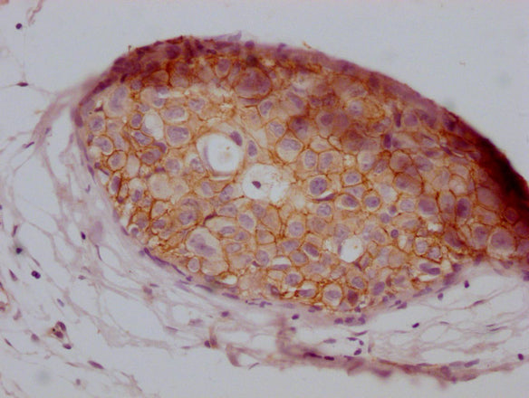 IHC image of CSB-MA907551 diluted at 1:100 and staining in paraffin-embedded human breast cancer performed on a Leica BondTM system. After dewaxing and hydration, antigen retrieval was mediated by high pressure in a citrate buffer (pH 6.0). Section was blocked with 10% normal goat serum 30min at RT. Then primary antibody (1% BSA) was incubated at 4°C overnight. The primary is detected by a Goat anti-mouse IgG polymer labeled by HRP and visualized using 0.05% DAB.