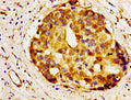 Immunohistochemistry of paraffin-embedded human breast cancer using CSB-PA001001LA01HU at dilution of 1:100