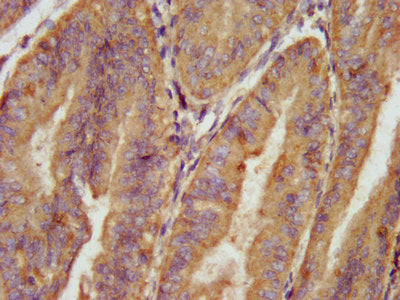 IHC image of CSB-PA001023LA01HU diluted at 1:100 and staining in paraffin-embedded human endometrial cancer performed on a Leica BondTM system. After dewaxing and hydration, antigen retrieval was mediated by high pressure in a citrate buffer (pH 6.0). Section was blocked with 10% normal goat serum 30min at RT. Then primary antibody (1% BSA) was incubated at 4&deg;C overnight. The primary is detected by a biotinylated secondary antibody and visualized using an HRP conjugated SP system.