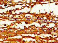 Immunohistochemistry of paraffin-embedded human melanoma using CSB-PA001050LA01HU at dilution of 1:100