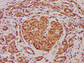 IHC image of CSB-PA001075LA01HU diluted at 1:100 and staining in paraffin-embedded human pancreatic cancer performed on a Leica BondTM system. After dewaxing and hydration, antigen retrieval was mediated by high pressure in a citrate buffer (pH 6.0). Section was blocked with 10% normal goat serum 30min at RT. Then primary antibody (1% BSA) was incubated at 4°C overnight. The primary is detected by a biotinylated secondary antibody and visualized using an HRP conjugated SP system.