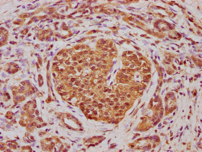 IHC image of CSB-PA001075LA01HU diluted at 1:100 and staining in paraffin-embedded human pancreatic cancer performed on a Leica BondTM system. After dewaxing and hydration, antigen retrieval was mediated by high pressure in a citrate buffer (pH 6.0). Section was blocked with 10% normal goat serum 30min at RT. Then primary antibody (1% BSA) was incubated at 4°C overnight. The primary is detected by a biotinylated secondary antibody and visualized using an HRP conjugated SP system.