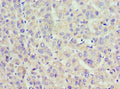 Immunohistochemistry of paraffin-embedded human liver cancer using CSB-PA001117ESR2HU at dilution of 1:100