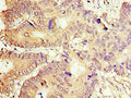 Immunohistochemistry of paraffin-embedded human colon cancer using CSB-PA001169ESR2HU at dilution of 1:100