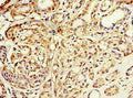 Immunohistochemistry of paraffin-embedded human breast cancer using CSB-PA001355ESR1HU at dilution of 1:100