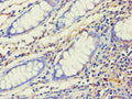 Immunohistochemistry of paraffin-embedded human colon cancer using CSB-PA001405ESR2HU at dilution of 1:100