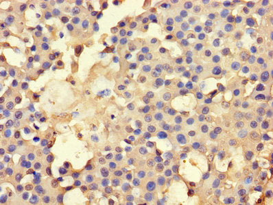 Immunohistochemistry of paraffin-embedded human breast cancer using CSB-PA001474LA01HU at dilution of 1:100