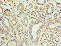 Immunohistochemistry of paraffin-embedded human breast cancer using CSB-PA001519ESR2HU at dilution of 1:100