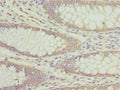 Immunohistochemistry of paraffin-embedded human colon cancer using CSB-PA001874ESR1HU at dilution of 1:100