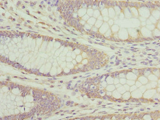 Immunohistochemistry of paraffin-embedded human colon cancer using CSB-PA001874ESR1HU at dilution of 1:100