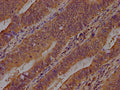 IHC image of CSB-PA002155LA01HU diluted at 1:400 and staining in paraffin-embedded human colon cancer performed on a Leica BondTM system. After dewaxing and hydration, antigen retrieval was mediated by high pressure in a citrate buffer (pH 6.0). Section was blocked with 10% normal goat serum 30min at RT. Then primary antibody (1% BSA) was incubated at 4°C overnight. The primary is detected by a biotinylated secondary antibody and visualized using an HRP conjugated SP system.