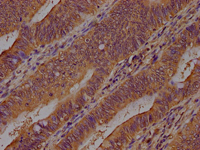 IHC image of CSB-PA002155LA01HU diluted at 1:400 and staining in paraffin-embedded human colon cancer performed on a Leica BondTM system. After dewaxing and hydration, antigen retrieval was mediated by high pressure in a citrate buffer (pH 6.0). Section was blocked with 10% normal goat serum 30min at RT. Then primary antibody (1% BSA) was incubated at 4°C overnight. The primary is detected by a biotinylated secondary antibody and visualized using an HRP conjugated SP system.