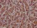 IHC image of CSB-PA002272LA01HU diluted at 1:100 and staining in paraffin-embedded human breast cancer performed on a Leica BondTM system. After dewaxing and hydration, antigen retrieval was mediated by high pressure in a citrate buffer (pH 6.0). Section was blocked with 10% normal goat serum 30min at RT. Then primary antibody (1% BSA) was incubated at 4°C overnight. The primary is detected by a Goat anti-rabbit polymer IgG labeled by HRP and visualized using 0.05% DAB.