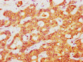 IHC image of CSB-PA002309LA01HU diluted at 1:400 and staining in paraffin-embedded human liver cancer performed on a Leica BondTM system. After dewaxing and hydration, antigen retrieval was mediated by high pressure in a citrate buffer (pH 6.0). Section was blocked with 10% normal goat serum 30min at RT. Then primary antibody (1% BSA) was incubated at 4°C overnight. The primary is detected by a biotinylated secondary antibody and visualized using an HRP conjugated SP system.
